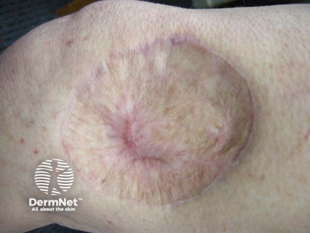 A skin graft after melanoma excision on the knee