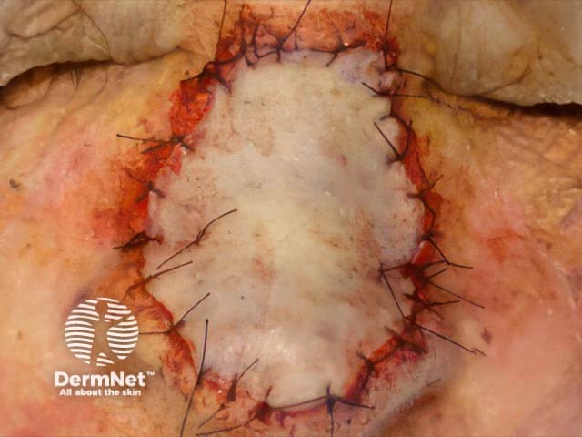 A full-thickness skin graft sutured in place immediately post-operatively