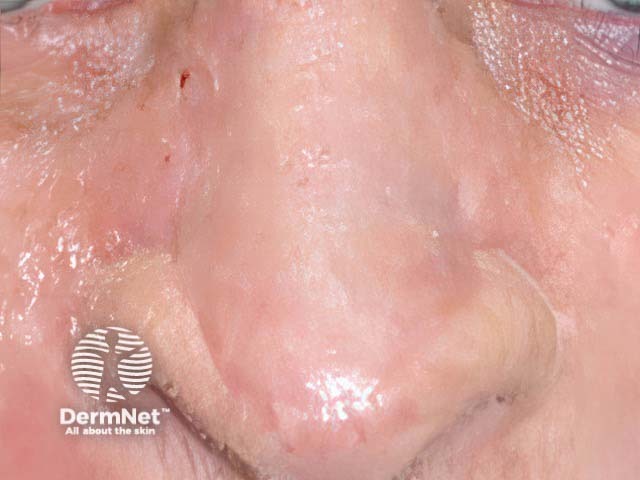 One year after nasal full-thickness skin graft