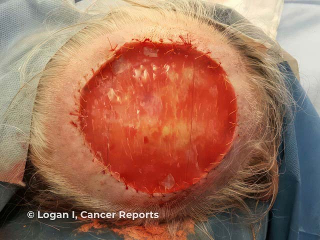 An acellular dermal matrix applied to the full-thickness pleomorphic dermal sarcoma excision site