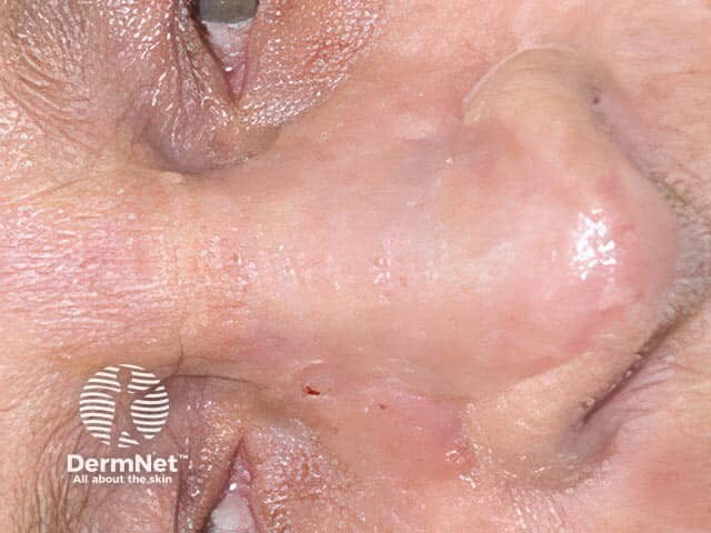 The established full thickness skin graft after skin cancer removal on the nose