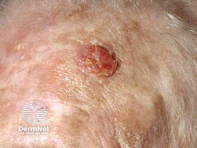 Scalp squamous cell carcinoma