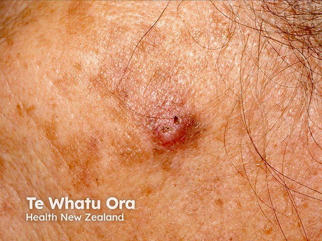 Cutaneous squamous cell carcinoma in skin of colour