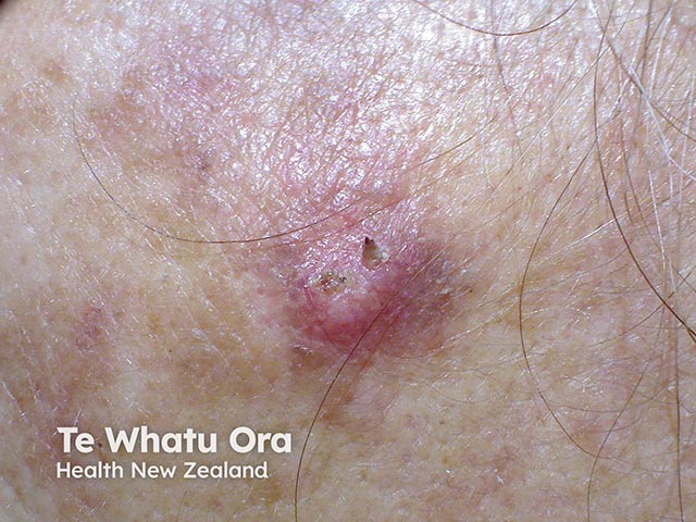 Cutaneous squamous cell carcinoma in skin of colour