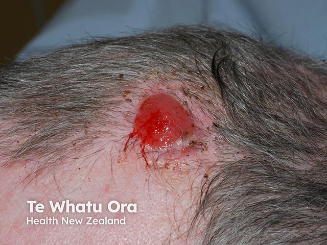 An ulcerated squamous cell carcinoma on the anterior scalp