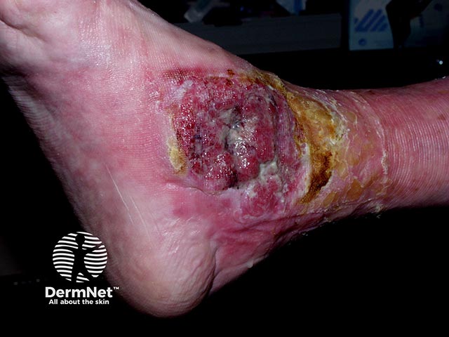 A squamous cell carcinoma has arisen within a longstanding venous ulcer