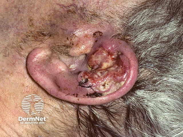 An ulcerated squamous cell carcinoma on the ear; there is enlargement of the pre-auricular lymph node due to spread of the tumour