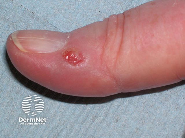 A slowly-growing ulcer on the thumb - histology showed a squamous cell carcinoma