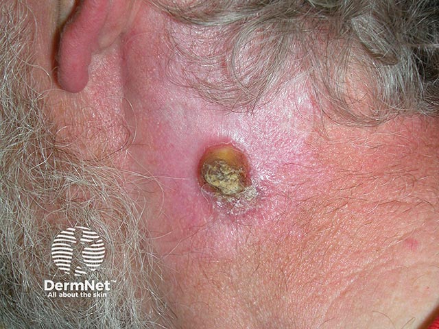 A hyperkeratotic invasive squamous cell carcinoma has arisen in Bowen's disease on the neck