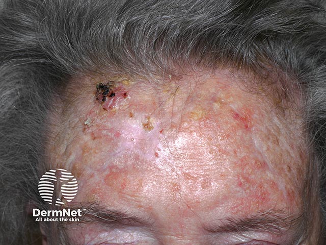 A hyperkeratotic squamous cell carcinma on severely sun-damaged facial skin