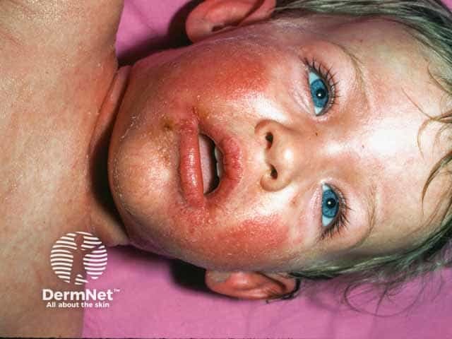 Erythema, scaling and crusting in an infant with staphylococcal scalded skin syndrome