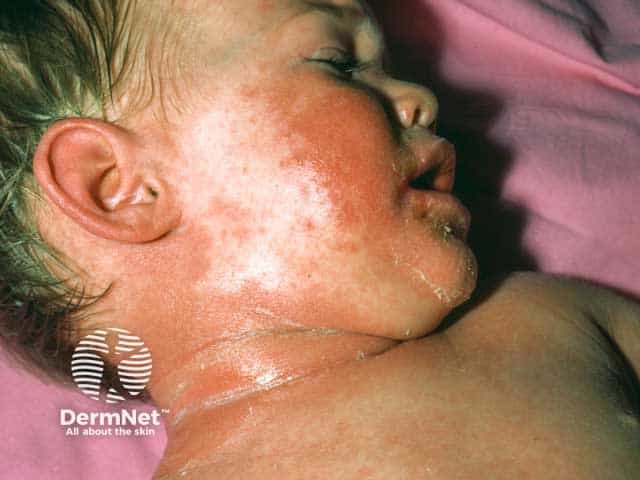 Erythema, scaling and crusting in an infant with staphylococcal scalded skin syndrome