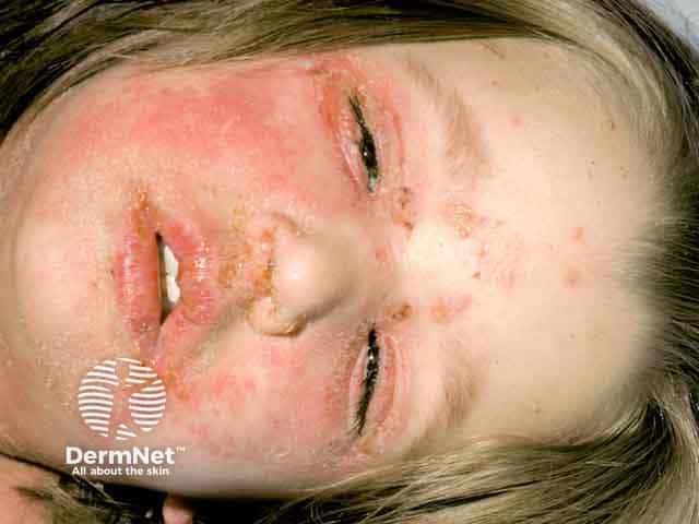 Erythema and crusting on the face in staphylococcal scalded skin syndrome