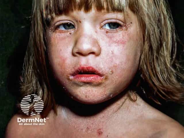 Erythema, scaling and crusting in a child with staphylococcal scalded skin syndrome