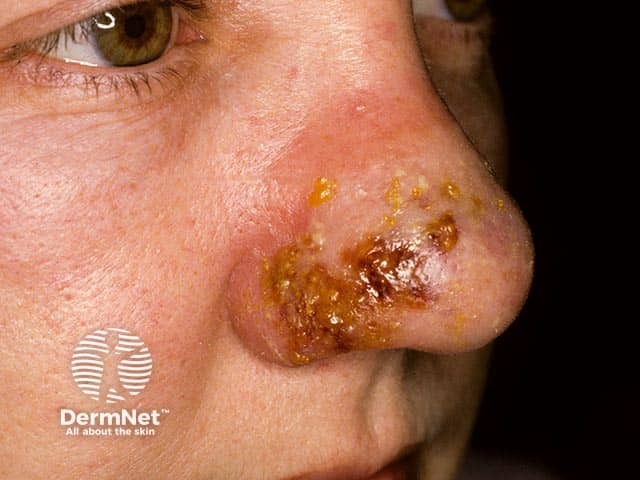 Nasal cellulitis due to a PVL staphylococcal infection