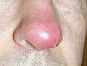 Staphylococcal skin infection