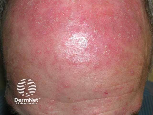 Steroid induced rosacea on the forehead
