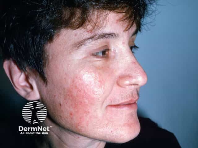 Steroid induced facial rosacea