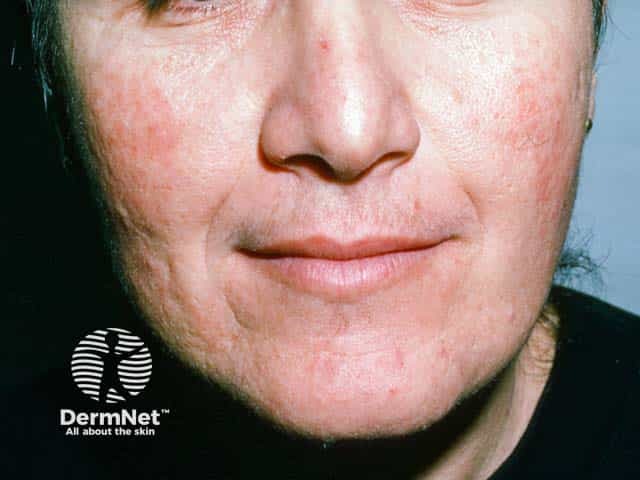 Steroid induced rosacea on the cheeks and chin