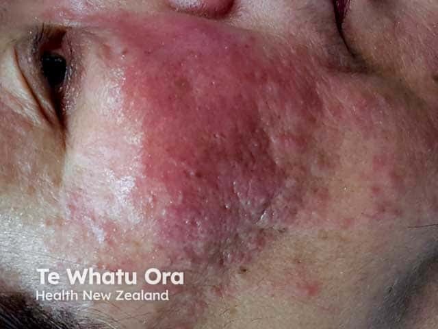 Swelling and papulopustules in steroid induced rosacea