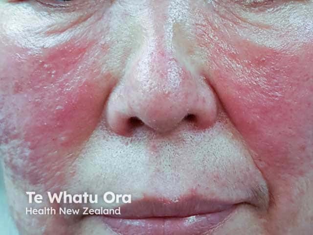Swelling and papulopustules in steroid induced rosacea