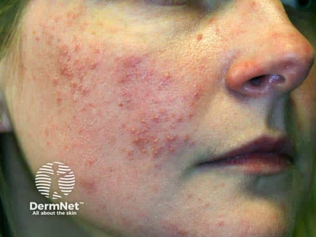Steroid induced papular rosacea