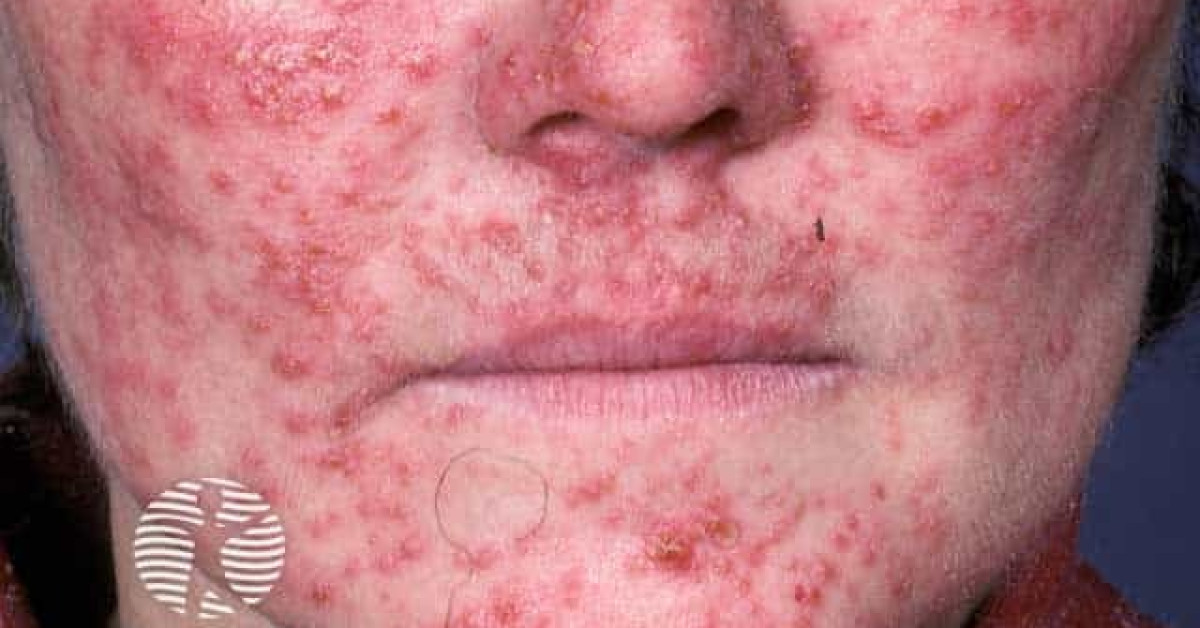 Dermnet® - Steroid Rosacea Image