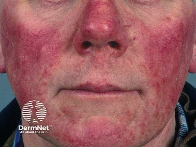 Steroid induced facial rosacea