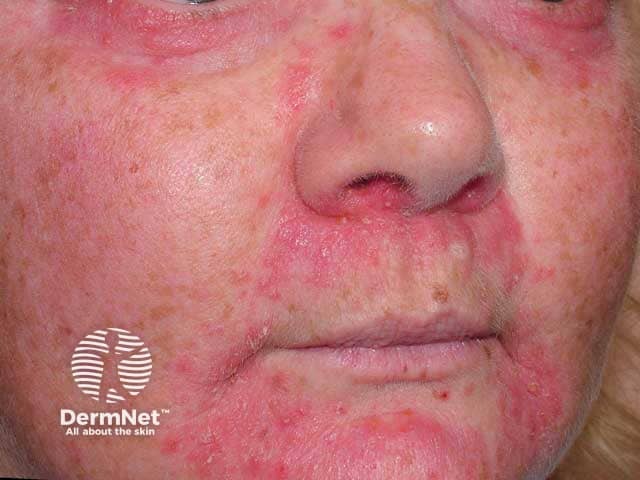 Steroid induced facial rosacea and perioral dermatitis