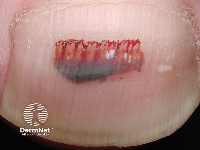 A red-purple lesion that arose after dropping a tool on the big toe - a subungal haemorrhage.  As the nail grows, the lesion will grow out then dissappear