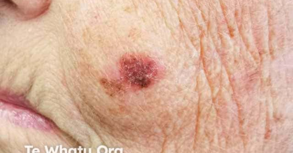 Superficial spreading melanoma image