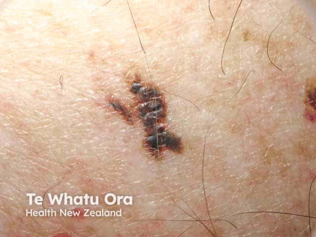 Multiple areas of notching of the border of this ugly duckling lesion - a malignant melanoma