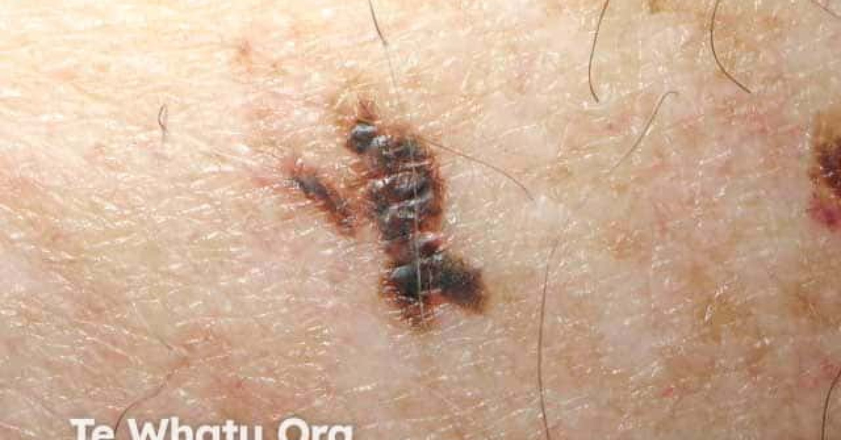 Superficial spreading melanoma image