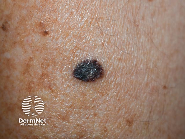 A superficial spreading melanoma on the forearm