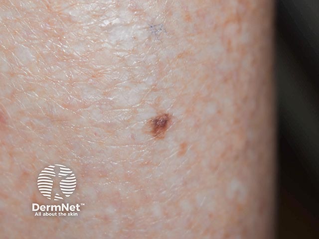 DermNet® - Images of Superficial Spreading Melanoma — DermNet