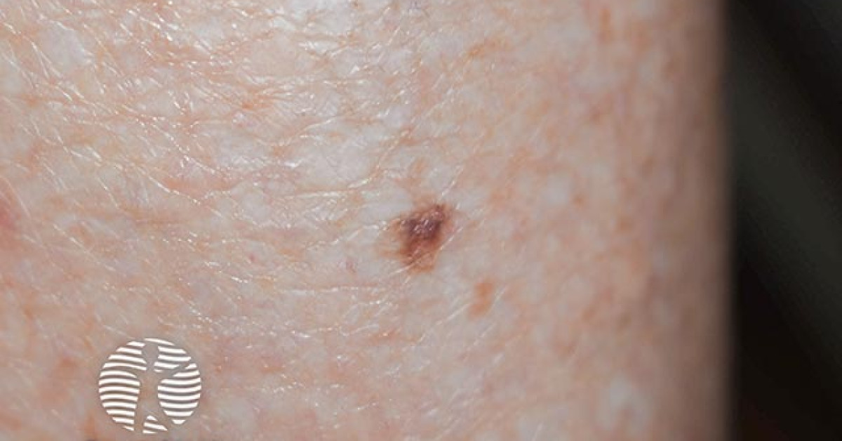 Superficial spreading melanoma image