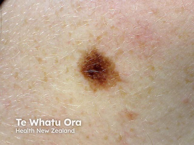 An irregularly marginated variably pigmented changing melanocytic lesion - it was a 0.5mm Breslow thickness melanoma<br />
