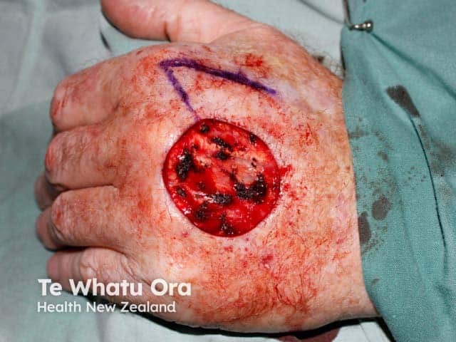 An intraoperative image before skin graft application