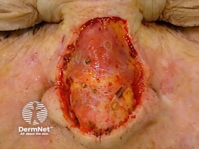 Wound after excision of large nasal skin cancer