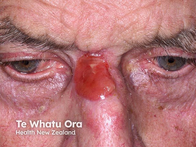 Ulceration and granulation tissue after excision of a nasal skin cancer