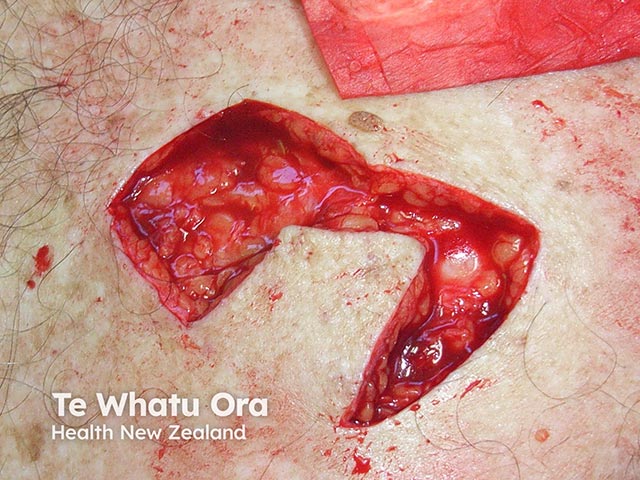 The defect left after removal of a skin cancer