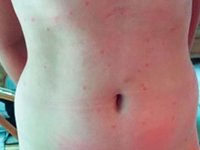 Swimmer's itch: anterior trunk