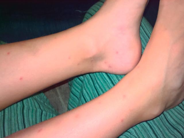 Swimmer's itch: legs