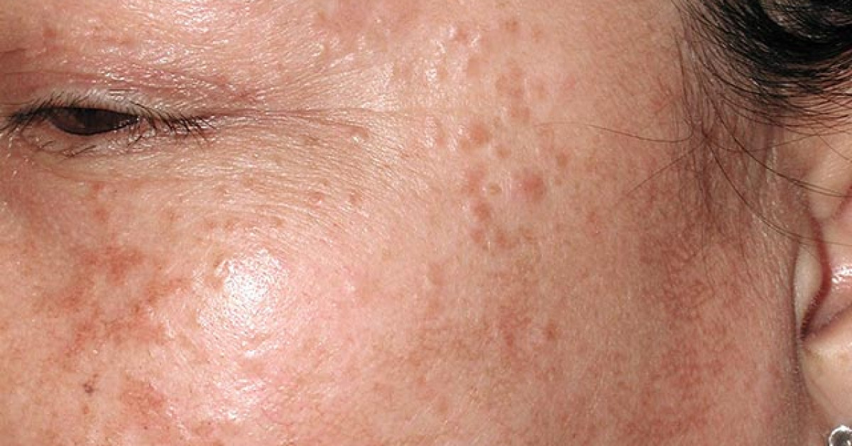 Stringo Mha Syringoma image