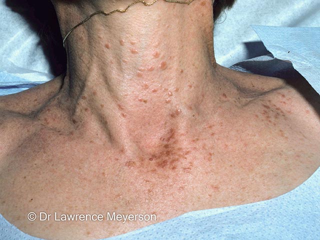 Syringomata on the neck and upper chest