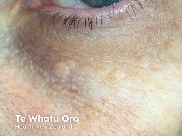 Syringoma Images Syringoma Images