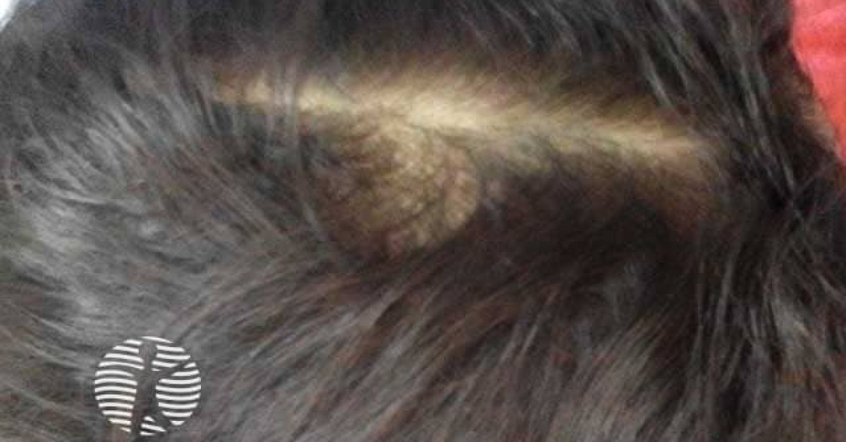 Telogen effluvium image
