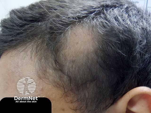 Clinical image of a male patient with patchy hair loss in the temporal area.