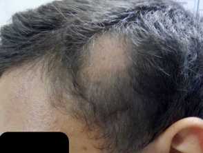Temporal triangular alopecia