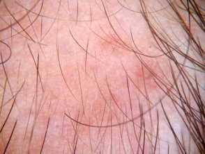 Temporal triangular alopecia
